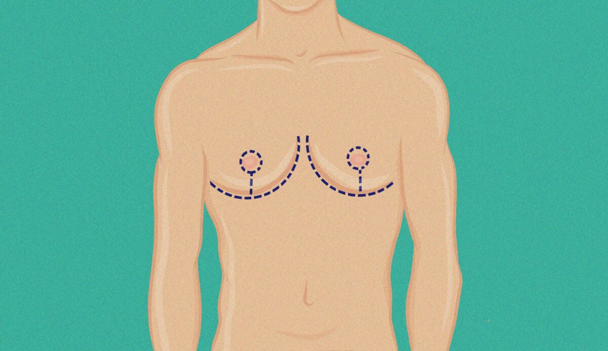 men-breast-reduction-surgery-563-16x9.jpg
